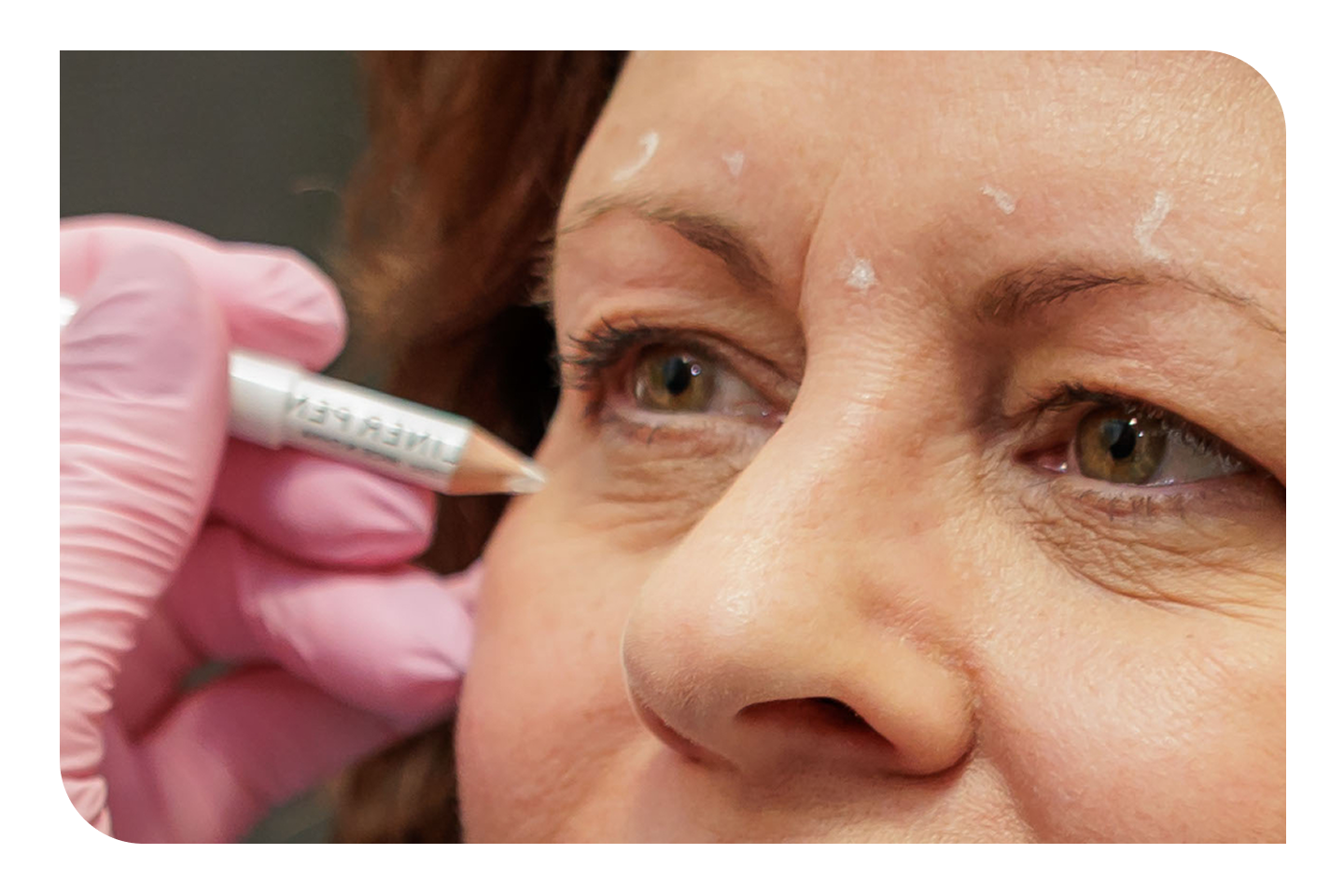 Facial markings for a cosmetic treatment