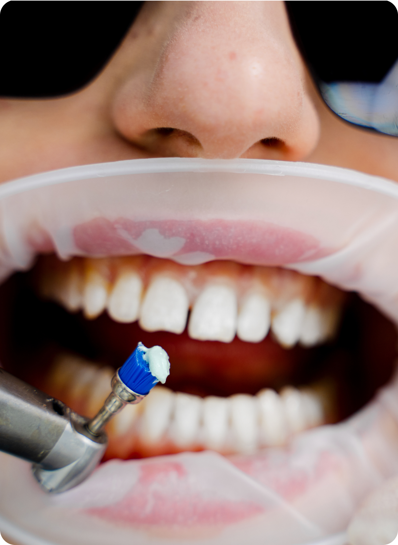 Remineralization guide: how to remineralize your teeth