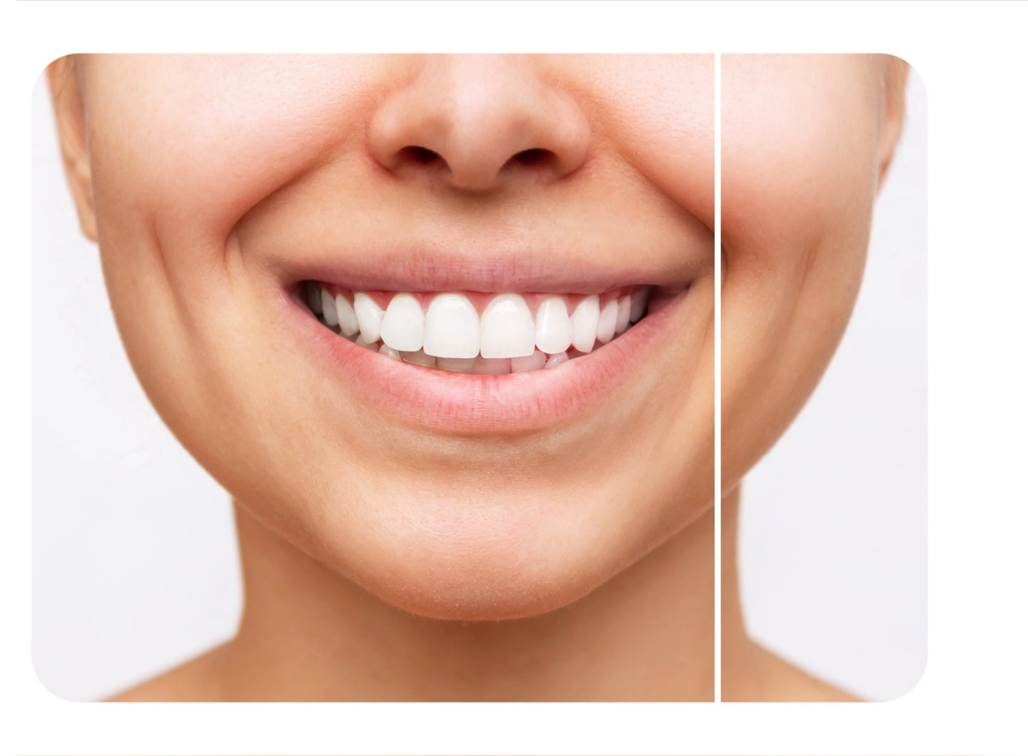 Close-up of a smiling mouth showing a before-and-after comparison of teeth whitening results, with visibly brighter teeth on one side.
