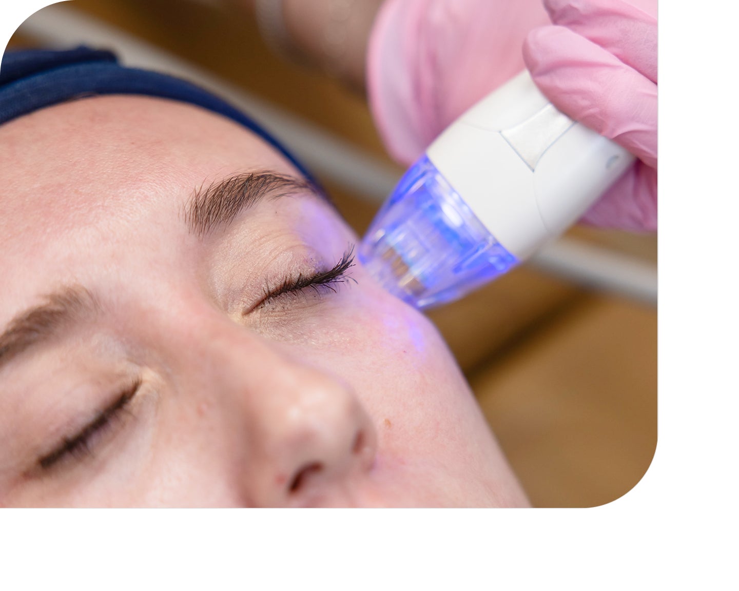 Microneedling with blue light therapy