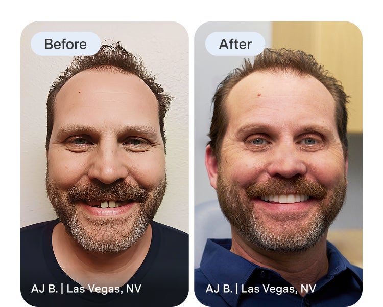 An Aspen Dental dentures patient highlights their before image and reveals their new smile after treatment.