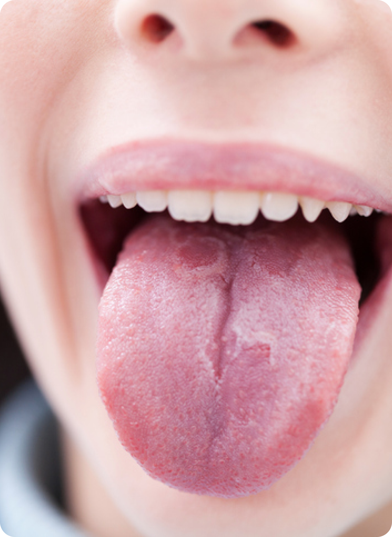 What is geographic tongue? Benign migratory glossitis 