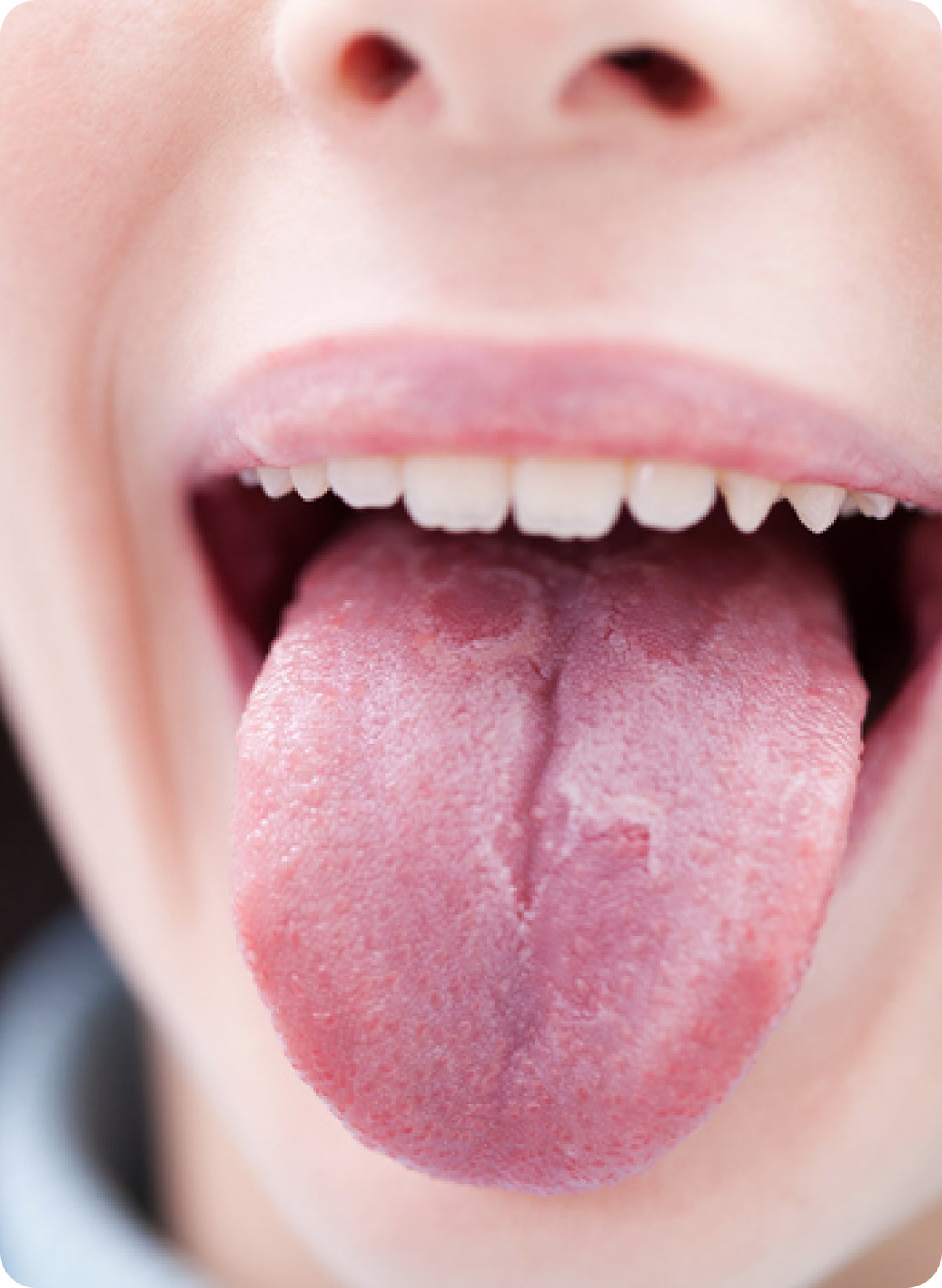 geographic-tongue-causes-symptoms-treatment-guide-aspen-dental