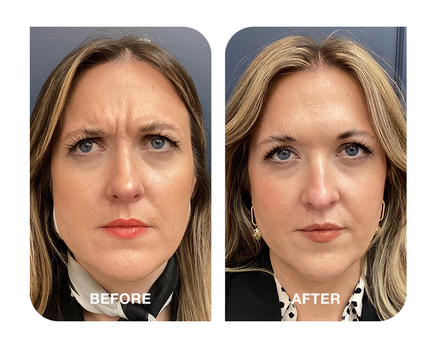 Before and after comparison showing reduced frown lines and a smoother forehead