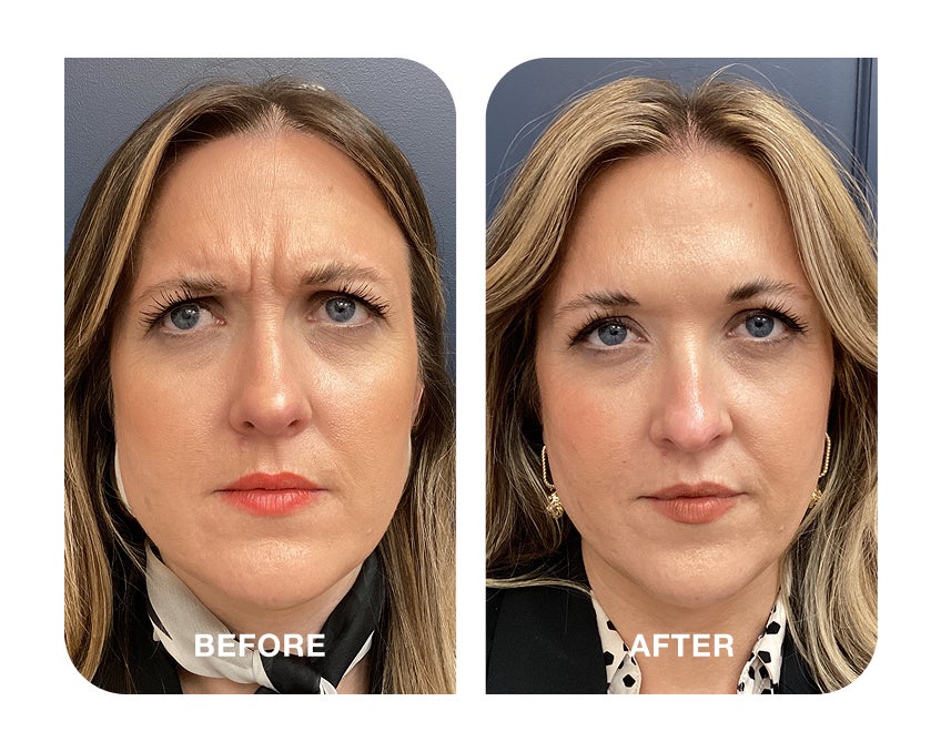 Before and after comparison showing reduced frown lines and a smoother forehead