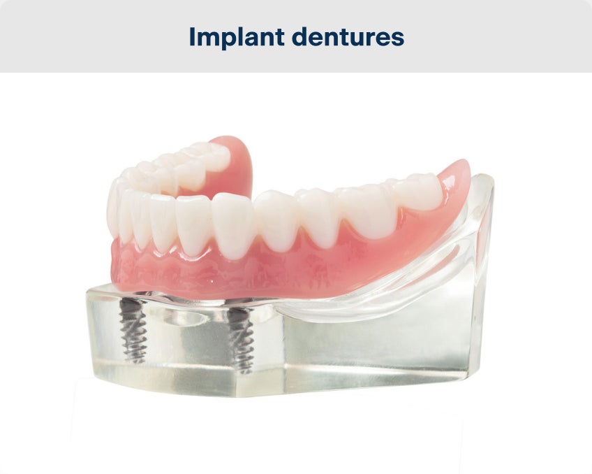A realistic model of a lower arch implant denture, anchored to the gums through two implant posts.