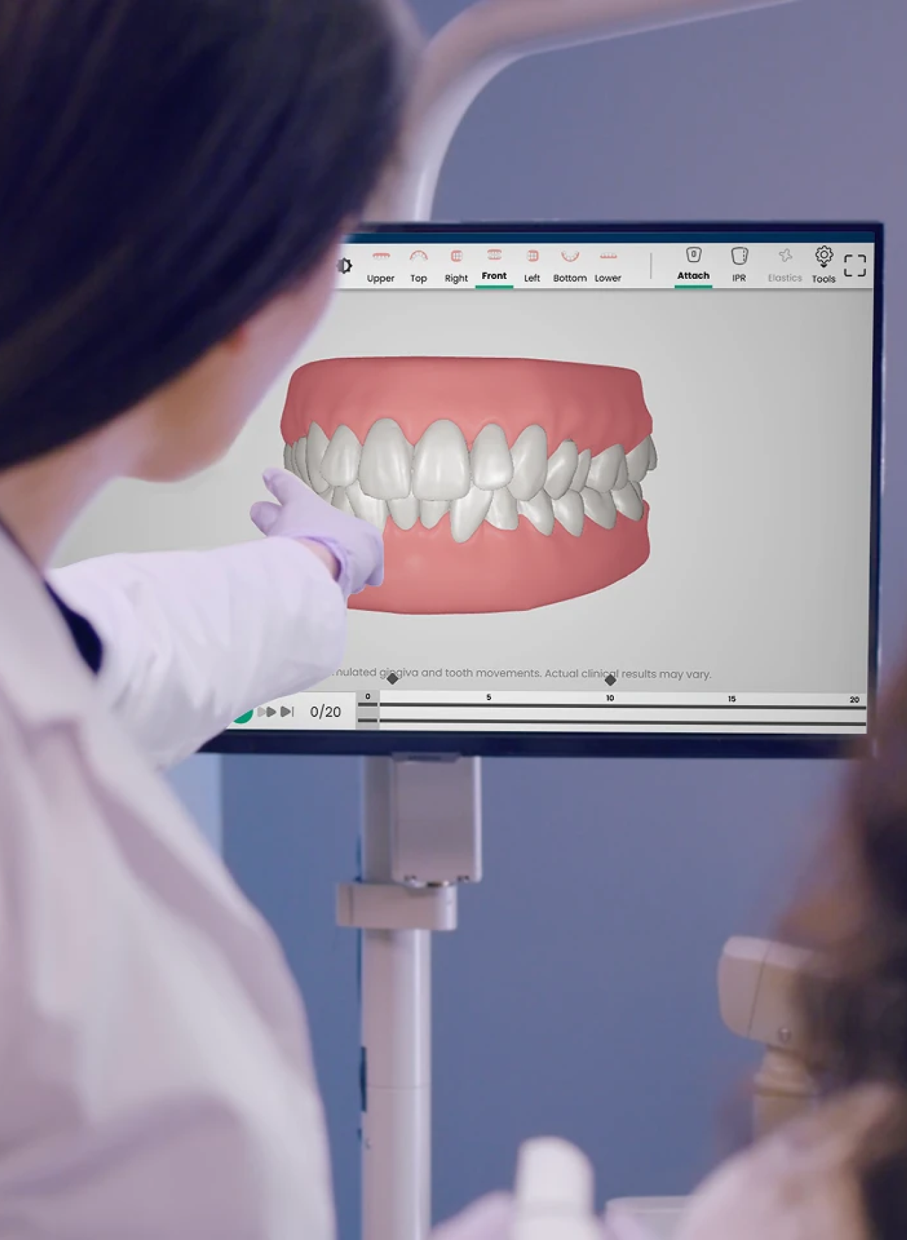 Can Clear Aligners Fix Crowded Teeth?