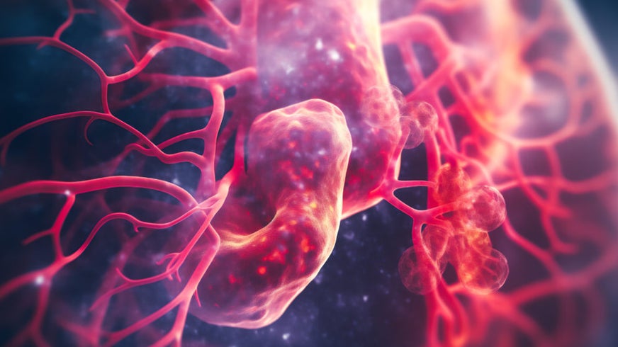 Close up of a lung with cancer cells.