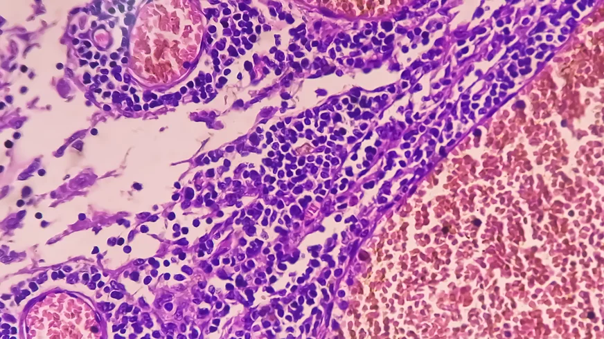 Gastric cancer ranks among the most prevalent cancers globally.