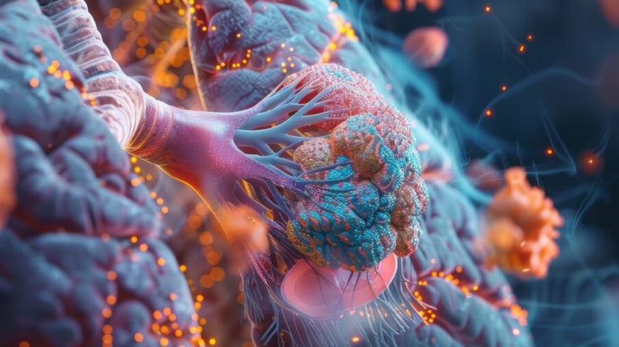 Primary Results From the Phase 3 EVOKE-01 Study: Sacituzumab Govitecan Versus Docetaxel in Patients With mNSCLC Previously Treated With Platinum-Based Chemotherapy and Anti–PD-L1 Inhibitors.