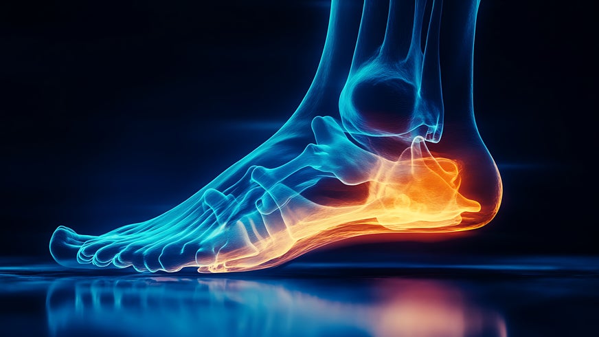 A close-up of a foot experiencing relief from the pain of Plantar Fibromatosis (PFI), a rare connective tissue disorder.
