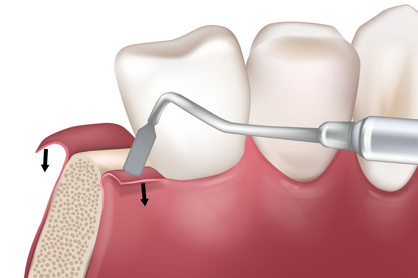 3D illustration of a dental procedure involving gum tissue adjustment, where a tool is used to reshape or reposition the gumline. This treatment helps address gum recession and improve periodontal health. Aspen Dental offers expert solutions for gum restoration and disease prevention.