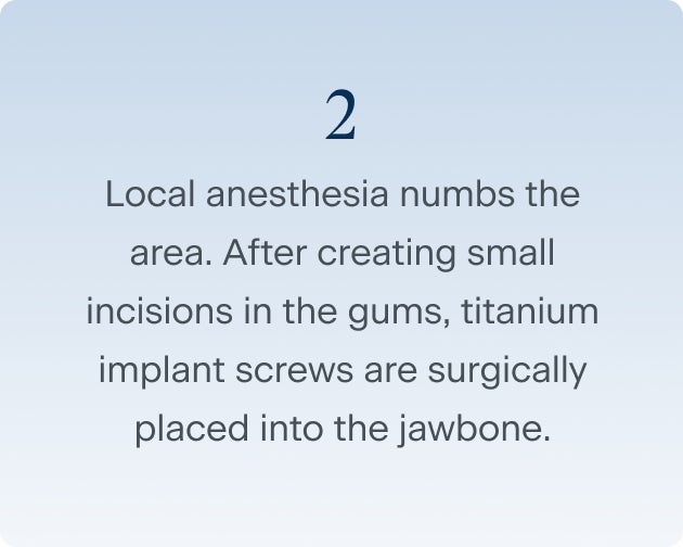 Step two of the dental implant surgery process, where local anesthesia is used to numb the area. After creating small incisions in the gums, titanium implant screws are surgically placed into the jawbone.