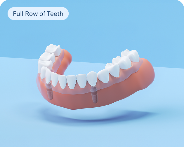  A 3D illustration of full-row implant-supported dentures for complete tooth replacement from Aspen Dental.