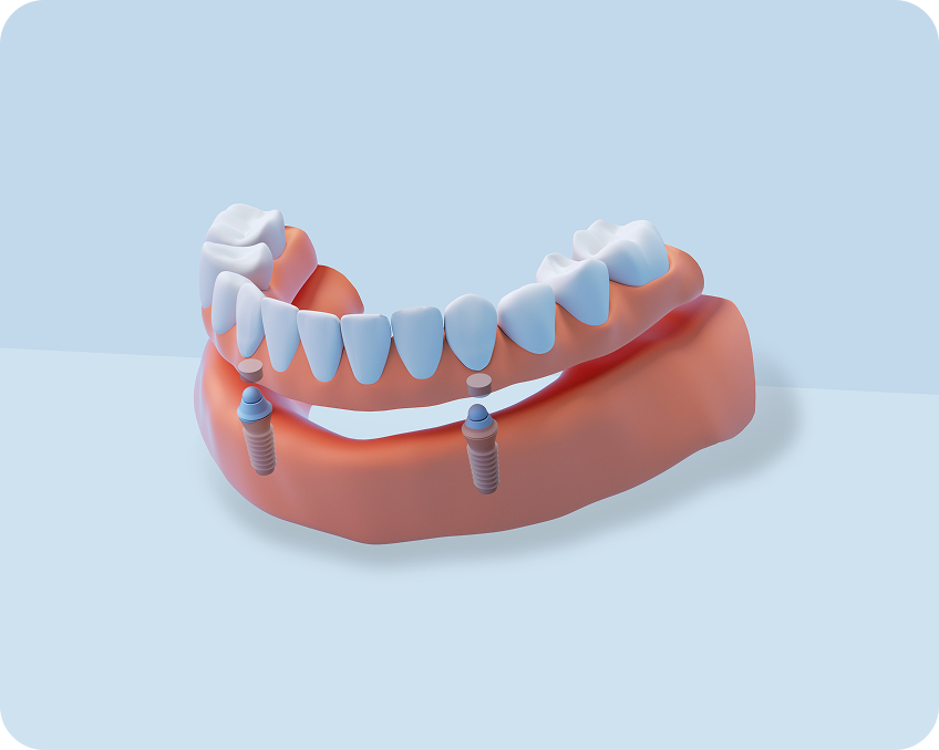 3D illustration of implant-supported dentures showcasing removable dentures secured by ClearChoice.
