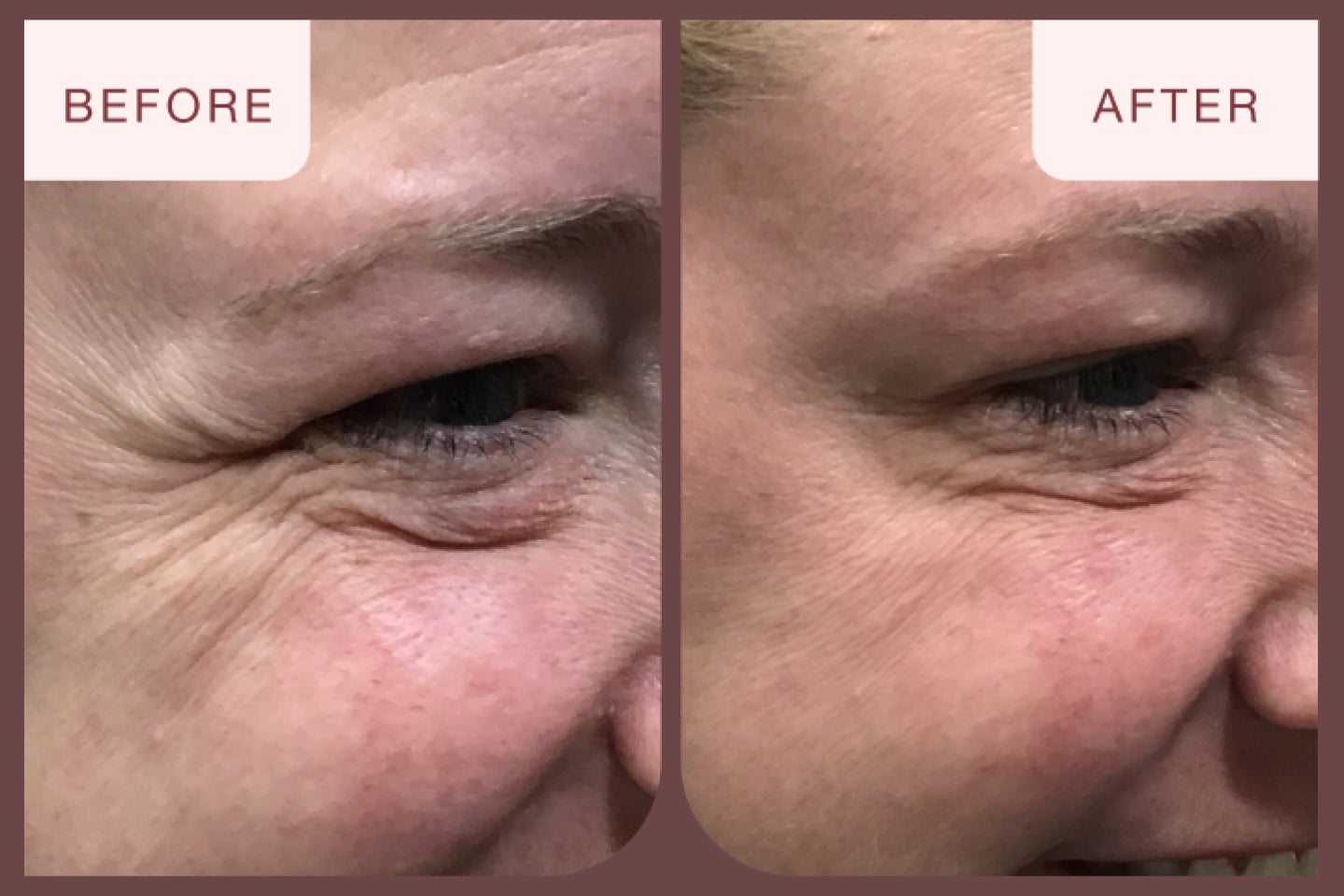 Before and after image of a botox treatment featuring fine lines and wrinkles around the eyes.