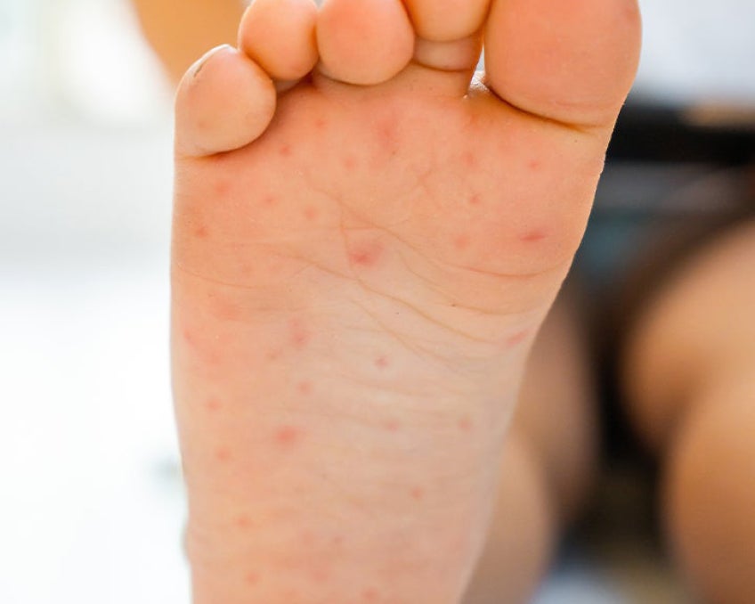 The bottom of a child's foot, showing sores from hand-foot-and-mouth disease