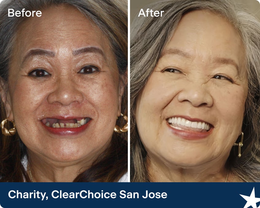 A before and after photo of Charity, a ClearChoice patient from the San Jose center, who regained her confidence after receiving dental implants.