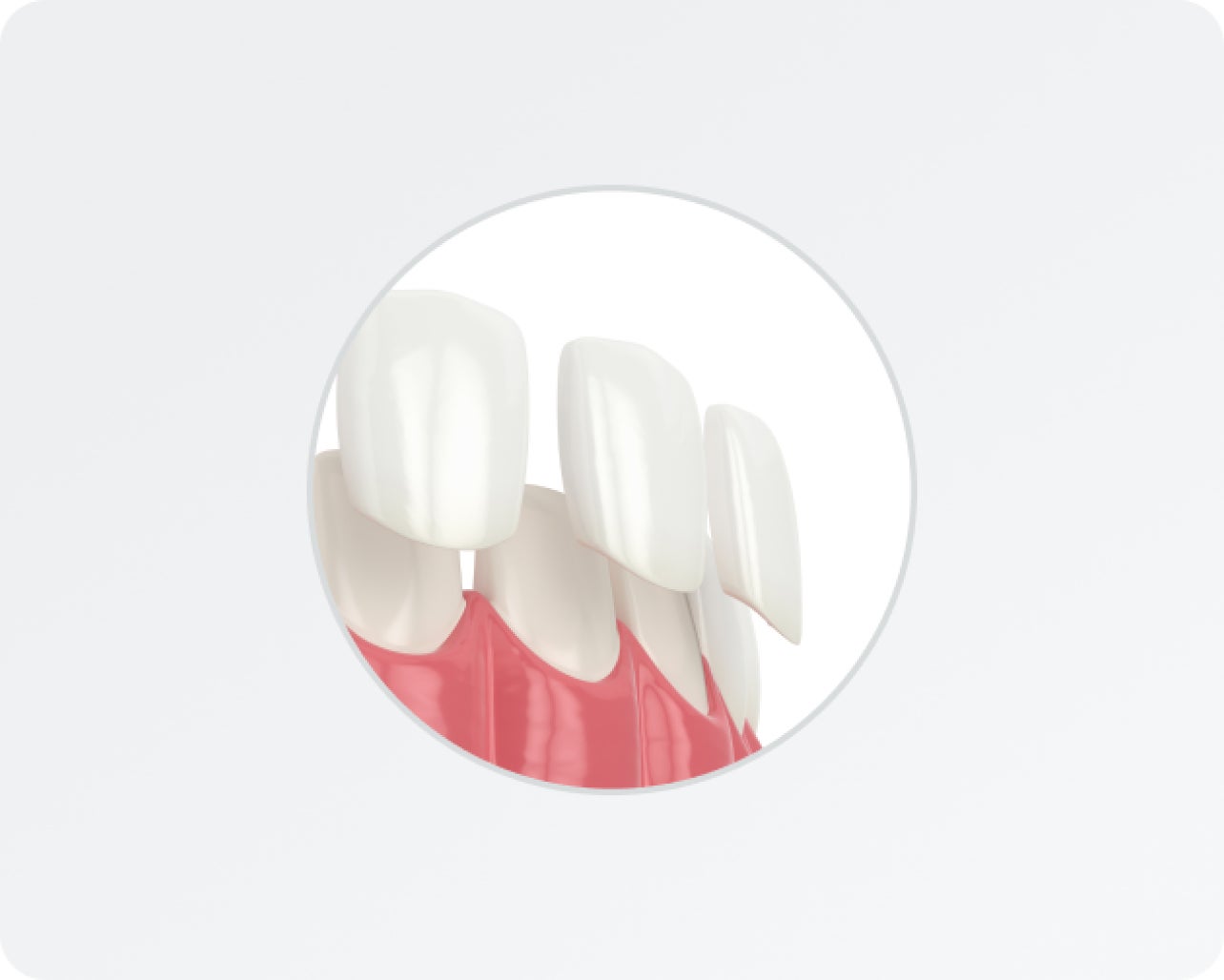  Illustration showing the application process of dental veneers, highlighting how thin veneers are placed over natural teeth for a seamless cosmetic enhancement by Aspen Dental.