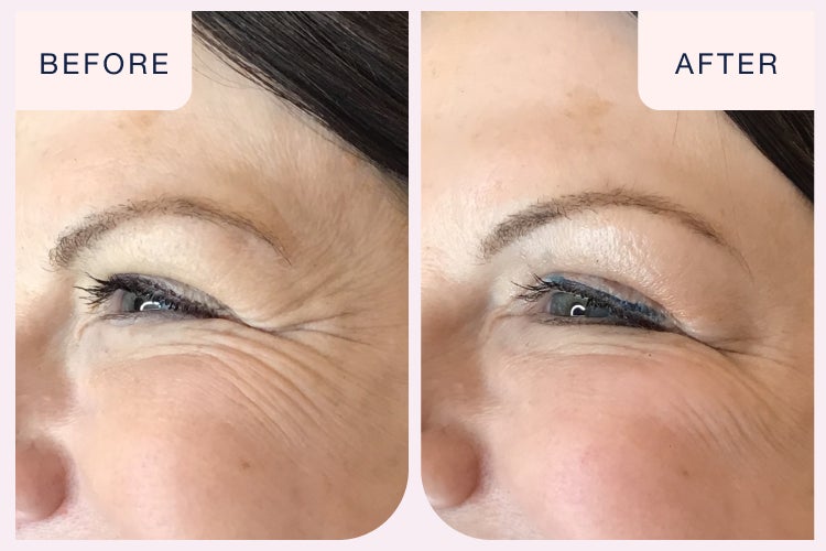 Before and after closeup image of a woman who received botox in the eye area at Chapter Aesthetic Studio.