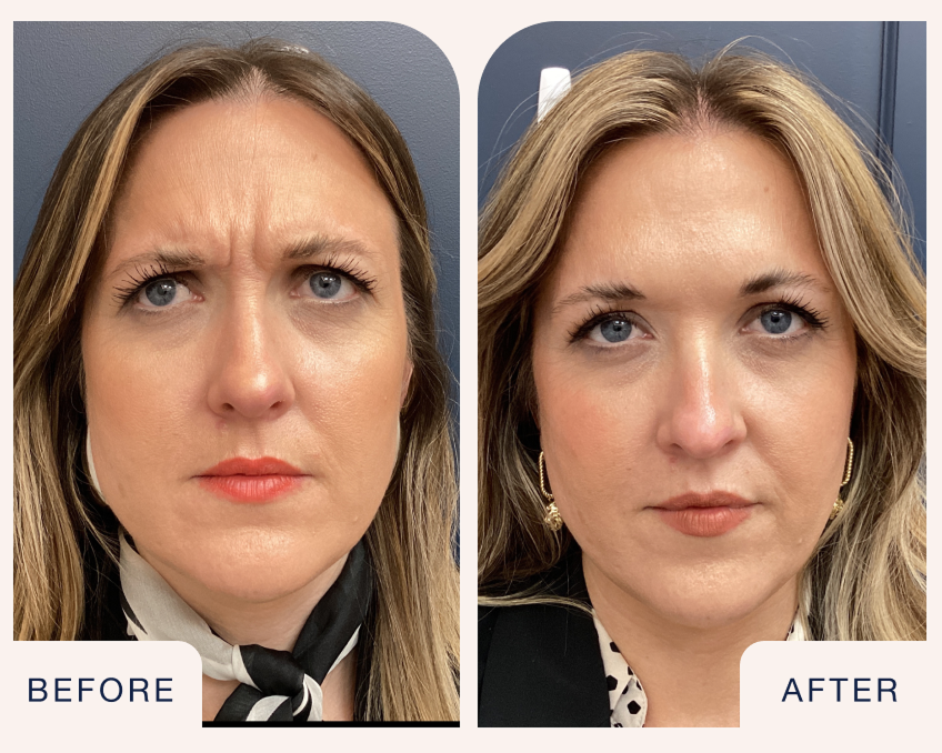 Botox before and after comparison of a woman’s forehead frown lines, showcasing treatment results at Chapter. Text on image reads “Before and After.”