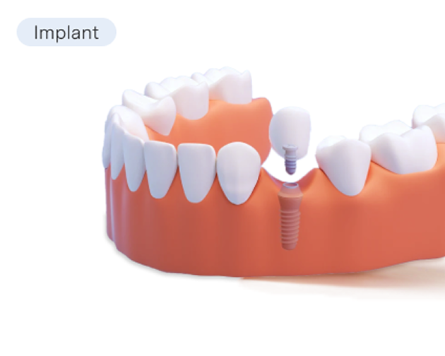 A model of an implant-supported crown, illustrating a single-tooth replacement anchored by a dental implant. The image emphasizes durability and a natural appearance.
