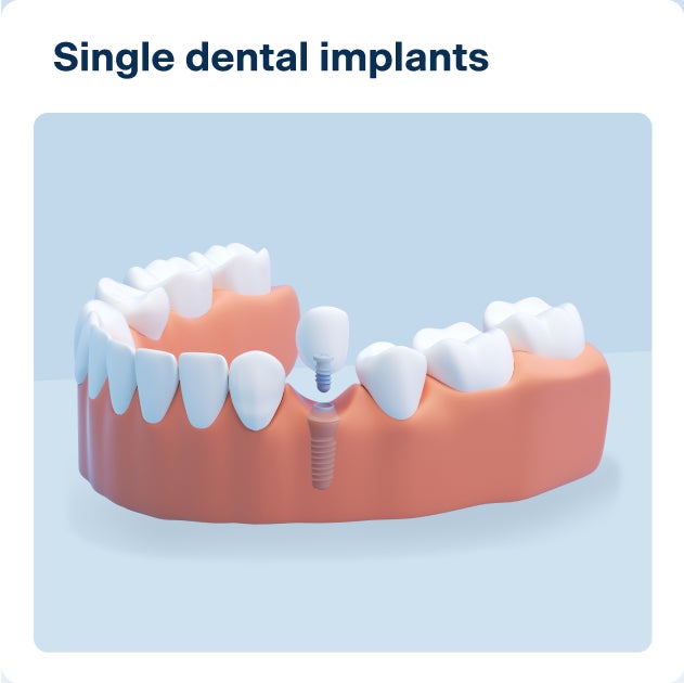 Single dental implant displayed in a lower jaw model with one replacement tooth; shows what a dental implant is and its role in single tooth restoration.