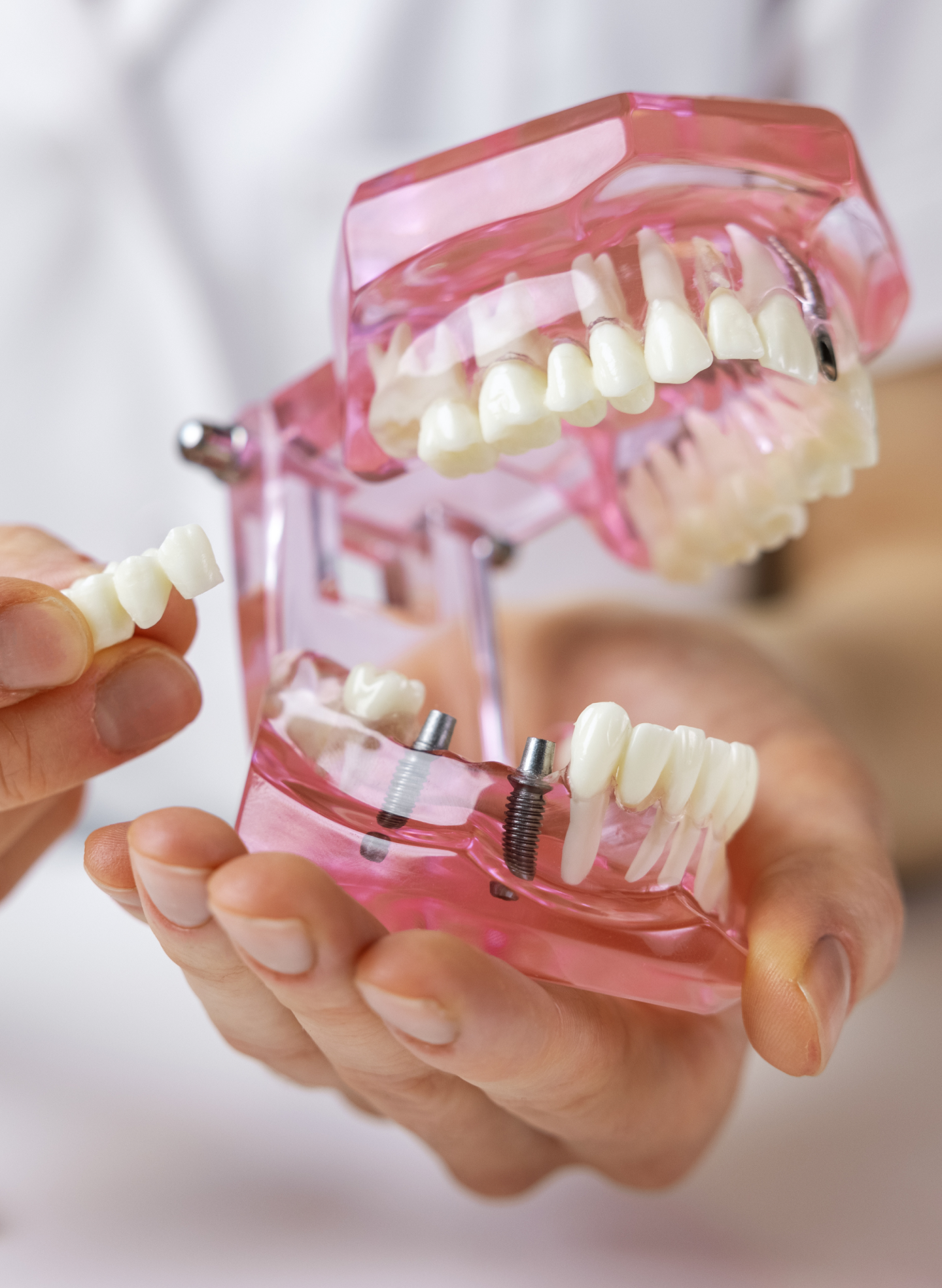 A clear model of teeth and dental implants held in a person's hands, demonstrating the structure and components of dental implants, related to understanding the cost of dental implants with insurance coverage through ClearChoice.