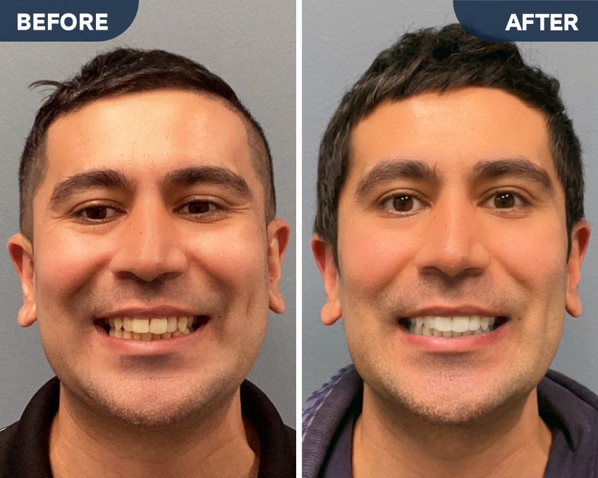 A side by side before and after comparison image of a middle aged man after receiving Motto clear aligners treatment