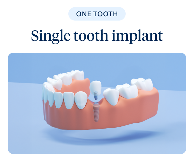 A 3D illustration of a single tooth implant showing one tooth restoration, highlighting Aspen Dental's single tooth replacement option.