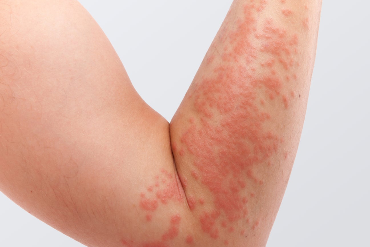 A photo of an arm irritated with a rash.