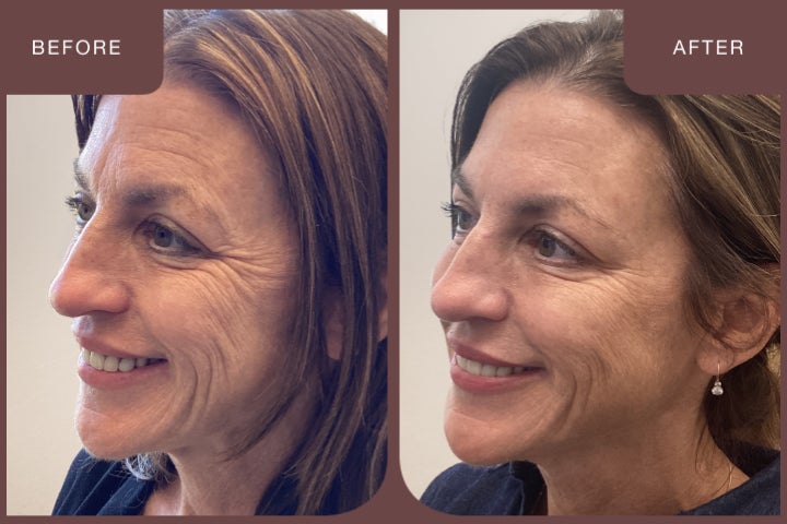 Before and after images of a guest treated with Radiesse.