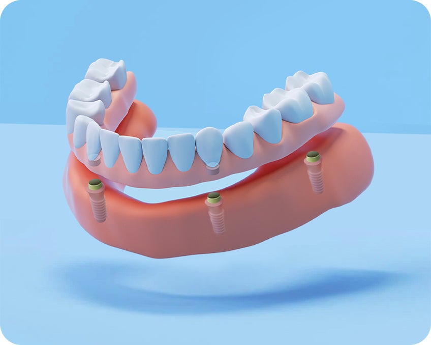 Full fixed arch implants model showing a complete row of teeth attached to four implants, offering a stable alternative to dentures.