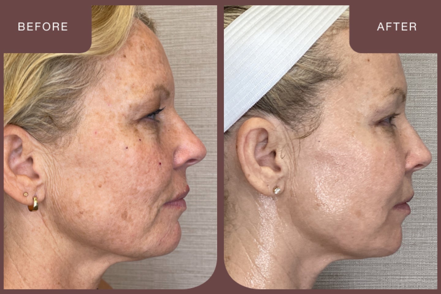 Closeup of images before and after a CoolPeel treatment.