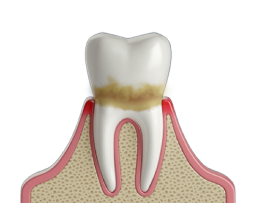 3D illustration of a tooth with significant plaque buildup along the gumline, depicting the progression of gum disease. The inflamed gum tissue suggests early periodontal issues. Aspen Dental offers professional treatments to remove plaque and restore gum health.