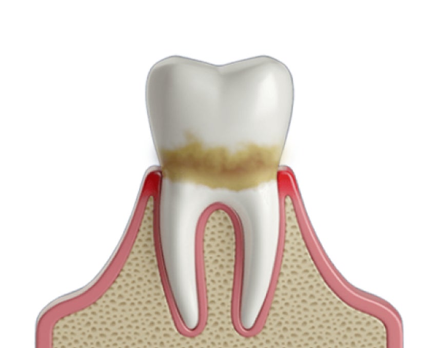 3D illustration of a tooth with significant plaque buildup along the gumline, depicting the progression of gum disease. The inflamed gum tissue suggests early periodontal issues. Aspen Dental offers professional treatments to remove plaque and restore gum health.