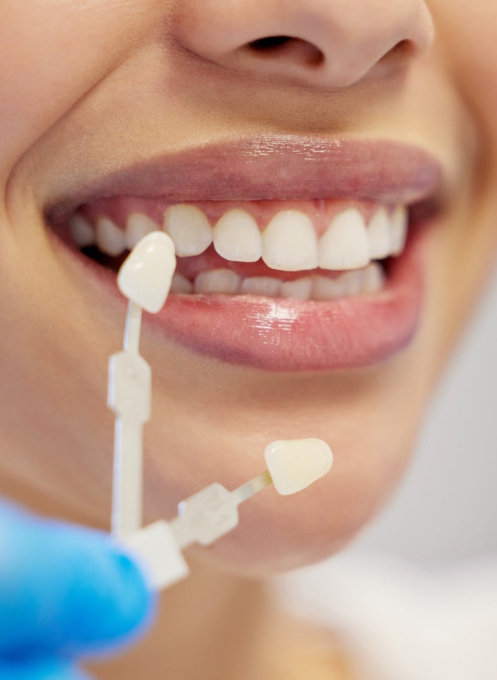 The Lifespan of Dental Veneers: How Long Do They Really Last