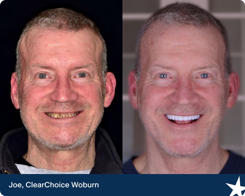Transformación dental de Joe en ClearChoice Woburn, mostrando su increíble cambio con implantes dentales.