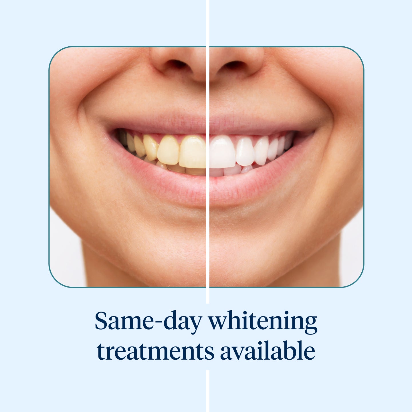 A close-up of a person's smile showing a before-and-after comparison of Aspen Dental's same-day teeth whitening treatment. The left side displays yellowed teeth, while the right side showcases a visibly brighter, whiter smile.