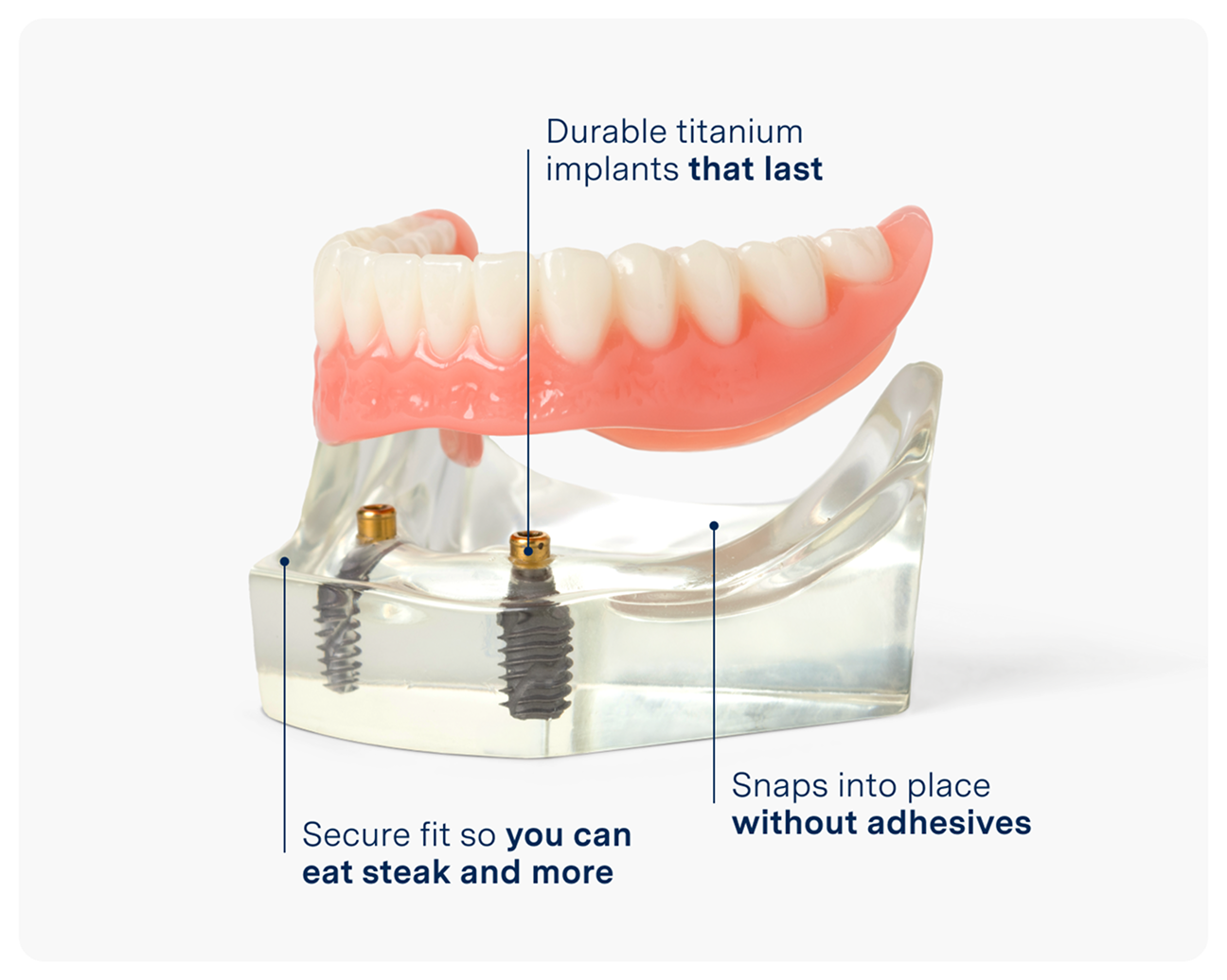 A dental model displaying snap-in dentures secured by durable titanium implants. Designed for a secure fit without adhesives, this implant solution allows for confident eating and long-lasting stability.