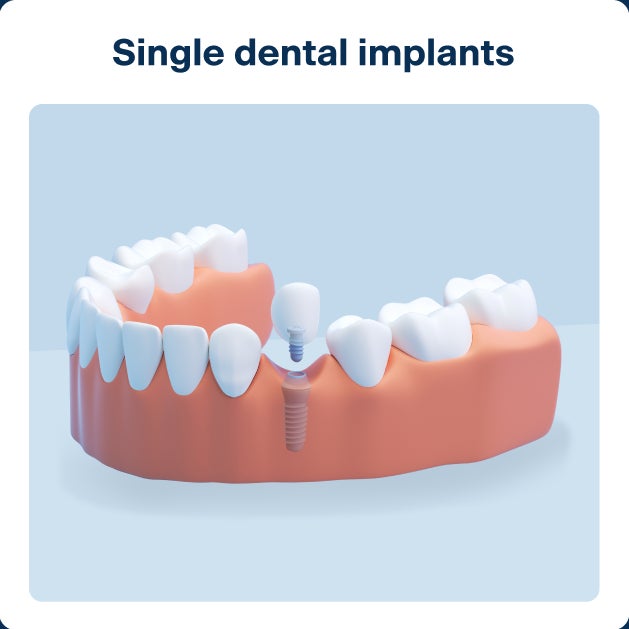 3D diagram of a single dental implant with one crown mounted on a lower jaw, used to illustrate a cost-effective solution in dental implants for replacing a single missing tooth.