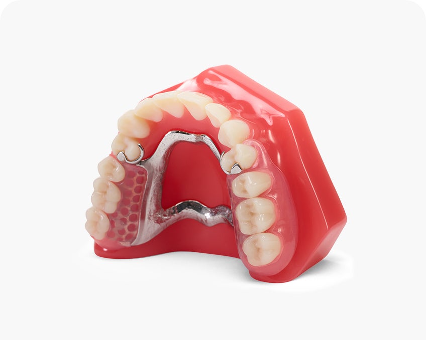 A red model shows a partial denture with a metal framework and artificial teeth replacing only the missing teeth in the upper jaw.