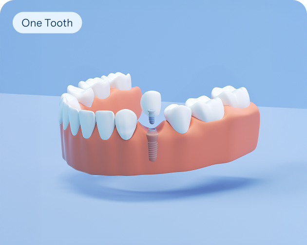  A 3D illustration of a single tooth dental implant replacing one tooth in the lower jaw, highlighting Aspen Dental's single tooth replacement option.