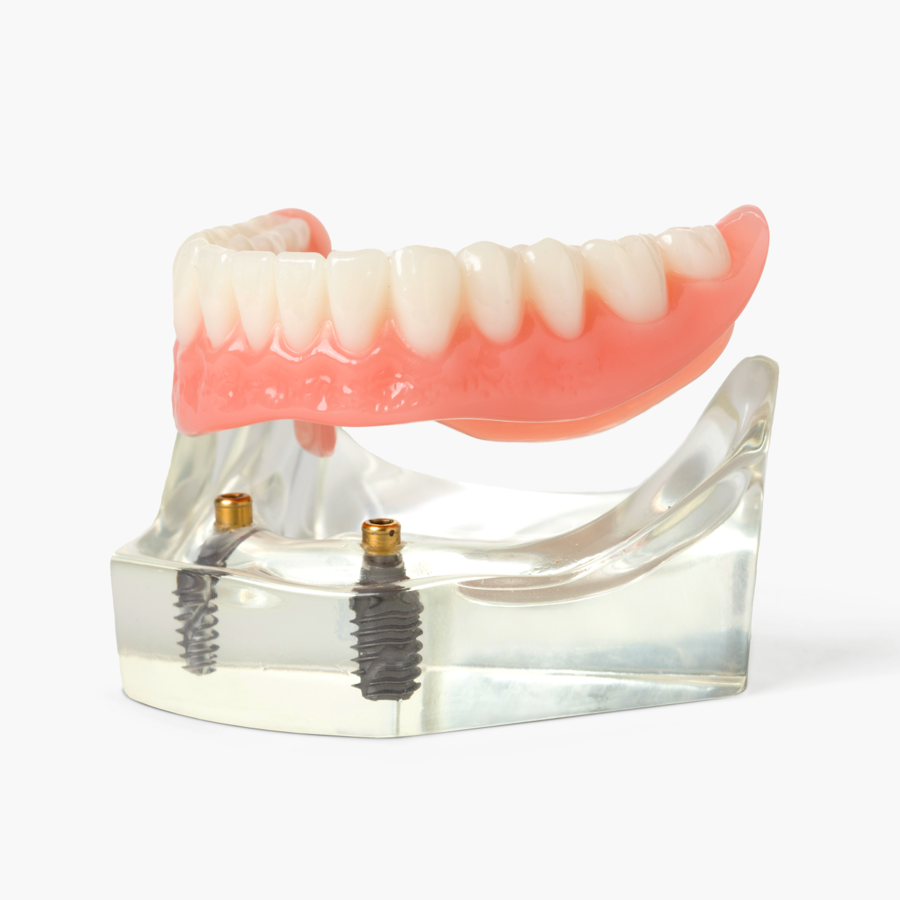 Aspen Dental implant denture model displaying a lower arch with dental implants securely attached to a transparent base, highlighting stability and design.