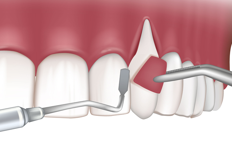 3D illustration of a gum flap surgery procedure, where a section of the gum is lifted to access and clean deep plaque and tartar buildup. This periodontal treatment helps restore gum health and prevent tooth loss. Aspen Dental provides expert surgical solutions for advanced gum disease.