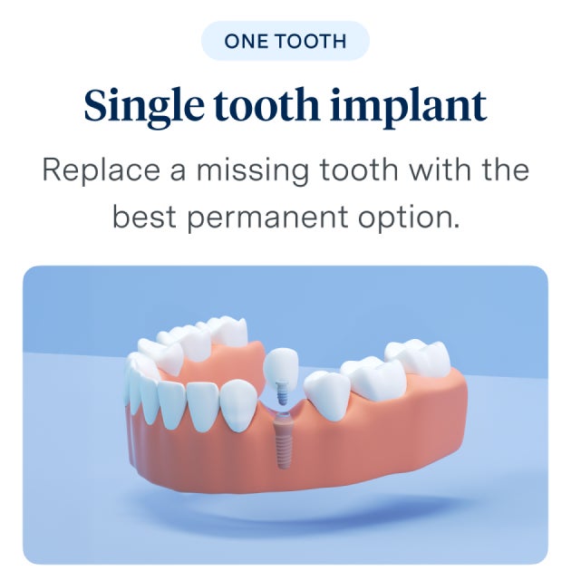 Single tooth implant - Replace a missing tooth with the best permanent option. 