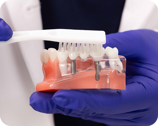 Brushing an implant-supported bridge model with a soft toothbrush – Aspen Dental cleaning guide.