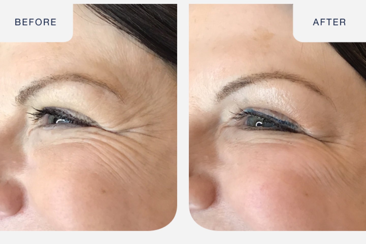 Before and after image of a botox treatment targeting crows feet.