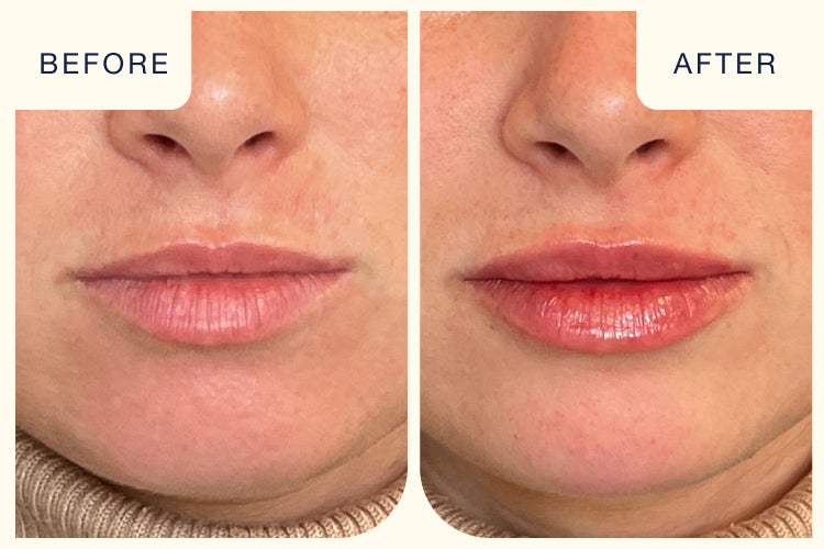 Before and after image of a lip filler treatment featuring fuller but natural looking lips.