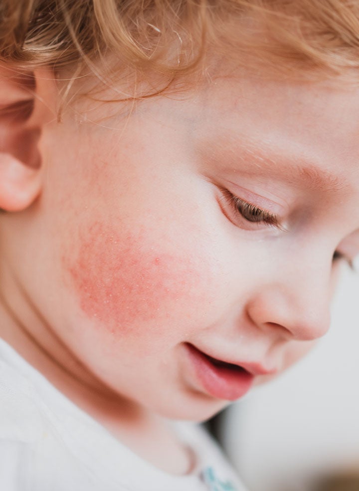 A young child with a red rash on their cheeks.